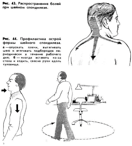 Спондилоартроз шейного отдела позвоночника - что это такое? - фото 5