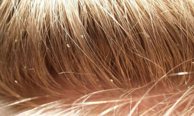 В Крыму растет количество заболевших педикулезом