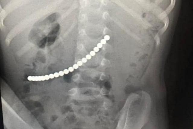 В Крыму спасли 4-летнего мальчика, наглотавшегося магнитов