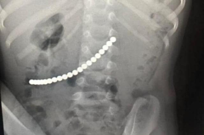 В Крыму спасли 4-летнего мальчика, наглотавшегося магнитов