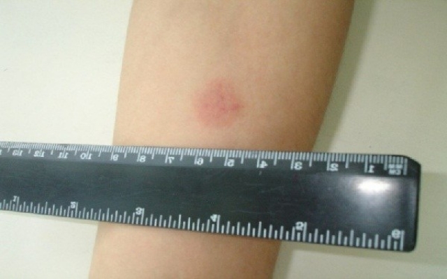 В Керчи растет заболеваемость туберкулезом среди детей